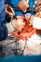 Close-up of the hands of surgeons performing a complex surgical operation in the open cavity of the...
