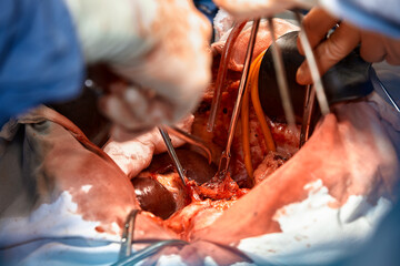 Close-up of the hands of surgeons performing a complex surgical operation in the open cavity of the...