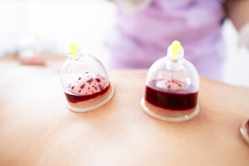 Close up view of hijama therapy cups filled with blood as part of alternative medicine.
