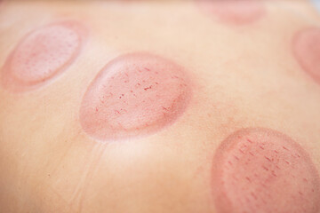 Close up view of hijama cupping marks on body after the treatment.