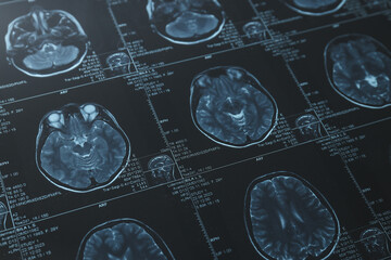 MRI or magnetic resonance imaging of the head and brain. Close up
