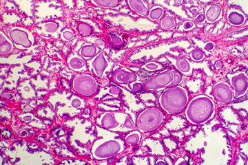 Micrograph of prostatic hyperplasia