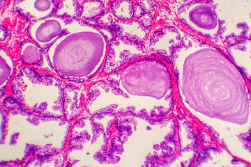 Micrograph of prostatic hyperplasia