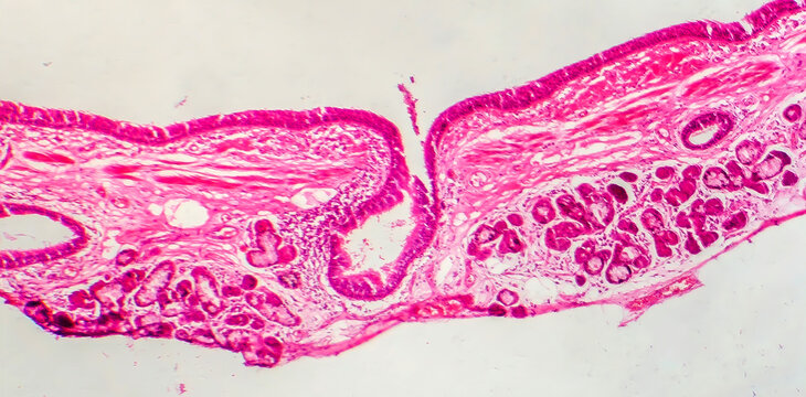 Photomicrograph of bronchial epithelial squamous metaplasia
