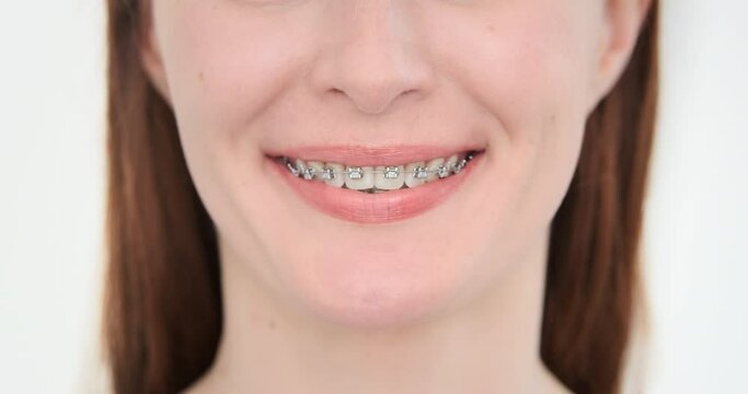 Close up, woman smile with metal braces. Female straight beautiful teeth. Dental care. Happy smiling female crop face. Mouth with orthodontic tooth treatment. Adult girl portrait with healthy teeth