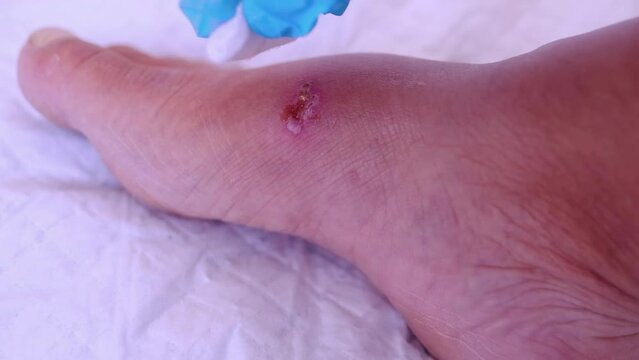 doctor treats weeping wound, trophic ulcer on female leg, wound exudate prevents healing ulcers by destroying growth factors, concept eliminating inflammatory process, sanitation pathogenic microflora