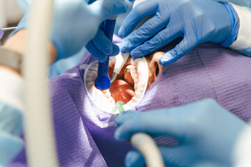 Patient with open mouth, selective focus on hands of dentist, treatment teeth with dental equipment