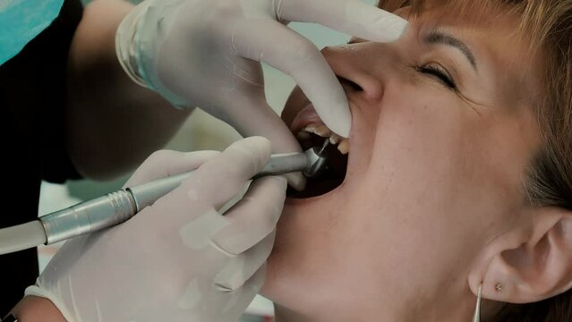 A dentist prepares a woman's teeth for the installation of ceramic veneers and crowns using a drill. preparation of teeth for prosthetics