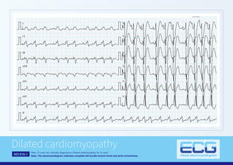 Male, 52 years old, clinically diagnosed as Dilated cardiomyopathy for 10 years. Cardiac ultrasound showed that the diameter of the LV was 85 mm, the LA was 38 mm, and the LVEF was 30.3%.