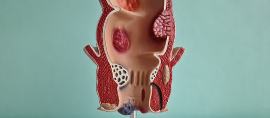 Model of unhealthy lower rectum with inflamed vascular structures