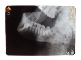 X-ray of a human jaw on a white