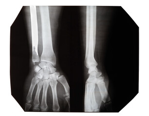 X-ray images of a hand with a fracture on a white