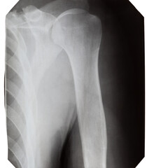X-ray of a man's shoulder on a white