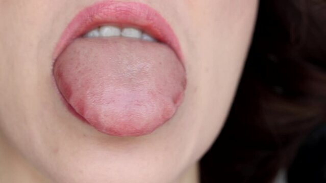 Woman shows swollen tongue from allergies