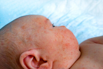 baby allergy skin. child dermatitis symptom problem rash. suffering atopic symptom on skin cheeks. concept child health. allergic reaction miliaria, prickly heat on baby's back.