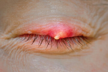 Chalazion on upper eyelid close up. Burst abscess with pus on eyelid. Chalazion on eyelid....