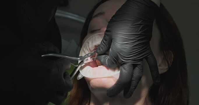 Dentist scrape off remnants of filling from the teeth. Close-up, open mouth, retractor, gloves