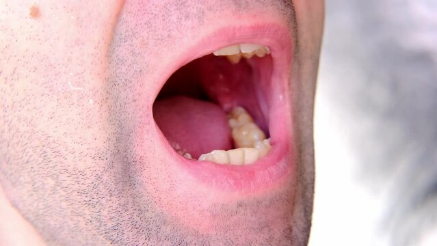 close-up of patient, young man with open mouth, dentist, doctor examines oral cavity, regular preventive examination, dentistry, dental treatment, dental prosthetics, caries prevention
