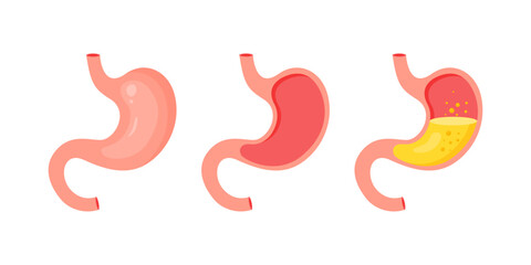 Healthy and unhealthy, empty and full human stomach. Internal organ, anatomy. Internal organ, human gastrointestinal tract. Organ of internal digestion system. Vector illustration in flat style