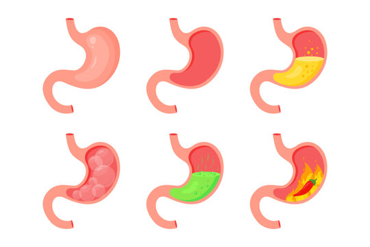 Human stomach. Healthy and unhealthy, empty and full human stomach. Bloating stomach ache, digestive tract pain fullness heaviness stomaches acid heartburn process indigestion