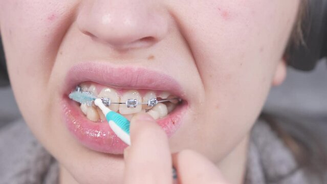 Teenager brushing metal brackets by orthodontic toothbrushes, dental floss. Dental care hygiene concept with braces. Cleaning braces teeth system, close-up. Oral care concept with braces.
