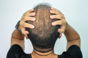 Rear view of bald spot on men's head. Baldness is related to your genes and male sex hormones. It usually follows a pattern of receding hairline and hair thinning on the crown.