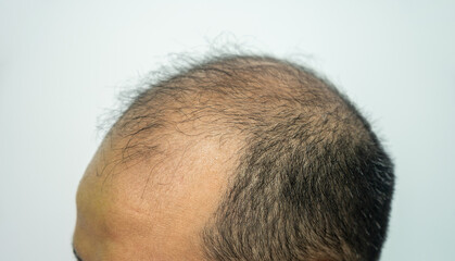 Side view of baldness men's scalp. Baldness is related to your genes and male sex hormones. - obrazy, fototapety, plakaty