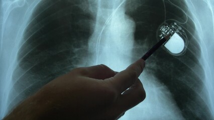 Doctor Examining X-Ray Image of Chest with Artificial Cardiac Pacemaker Implant - obrazy, fototapety, plakaty