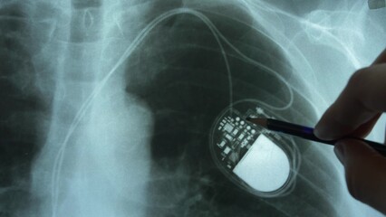 Doctor Examining X-Ray Image of Chest with Artificial Cardiac Pacemaker Implant