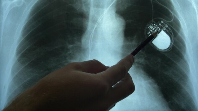 Doctor Examining X-Ray Image of Chest with Artificial Cardiac Pacemaker Implant