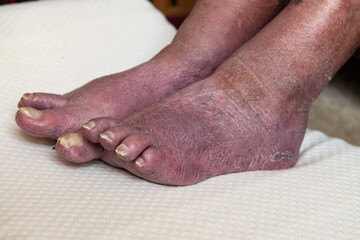 Bad circulation in elderly womans feet .