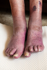 Bad ciculation in elderly womans feet.