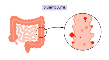 Diverticulitis and diverticulosis