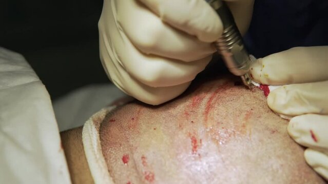 Hair Transplantation Patient in Clinic. Hair transplant patient during operation