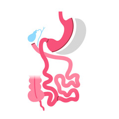 Fototapeta premium Biliopancreatic diversion procedure