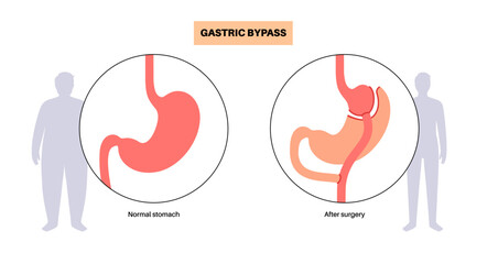Gastric bypass surgery
