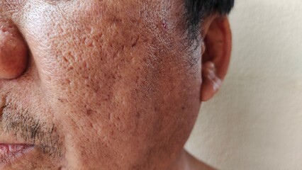 close up the Wrinkles and scar, freckles and blemish, blackhead and pimple, allergy and rash on the face of the male patient, health care and medical concept.