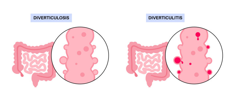 Diverticulitis and diverticulosis