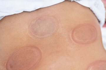 Close up view of hijama cupping marks on body after the treatment.