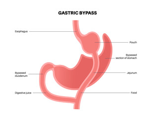Gastric bypass surgery - obrazy, fototapety, plakaty