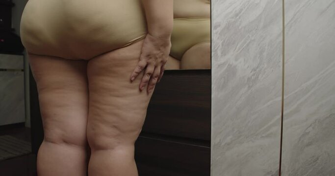 Asian oversize woman care about cellulite on her legs. Excess fat, Unhealthy lifestyle, Diet concept.