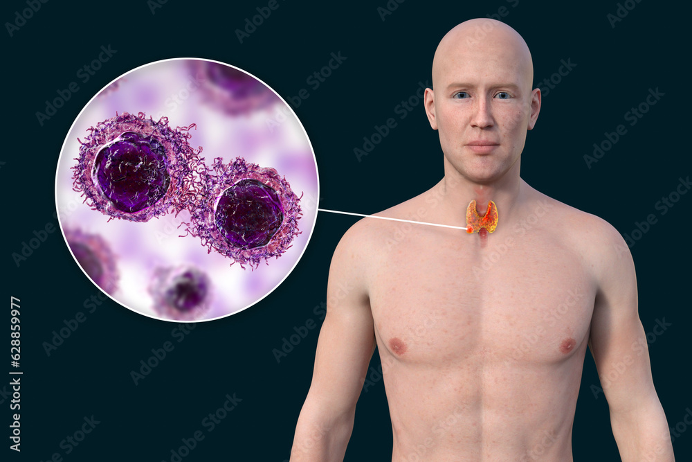 Sticker Thyroid cancer, 3D illustration