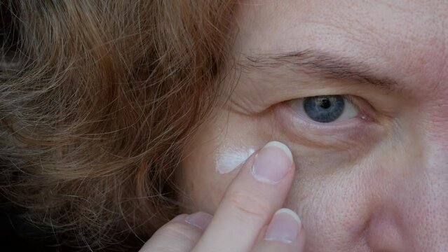 middle aged female's eye with drooping eyelid with cream cosmetic drop in finger. Ptosis is a drooping of the upper eyelid, lazy eye. Cosmetology and facial concept, first wrinkles