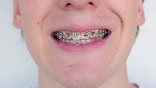 Teenage boy with braces showing teeth after visiting dentist