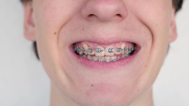 Teenage boy with braces showing teeth after visiting dentist