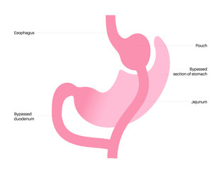 Gastric bypass surgery