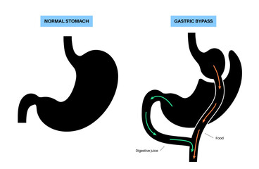 Gastric bypass surgery