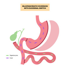 Biliopancreatic diversion procedure