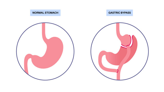Gastric bypass surgery
