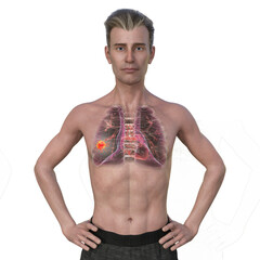 Fototapeta premium A 3D illustration of a man with transparent skin, revealing the presence of lung cancer.
